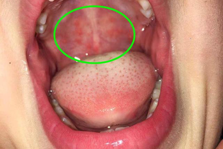 急性疱疹性咽峡炎红点图