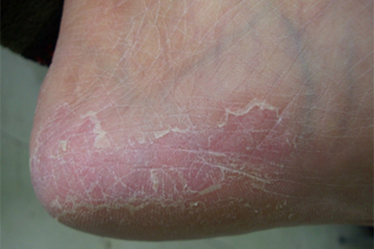 浸渍糜烂型足癣脚后跟症状图