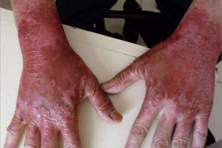 烟酸缺乏症手背症状图