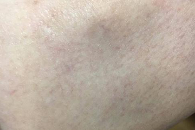 皮质类固醇激素后脂膜炎早期图