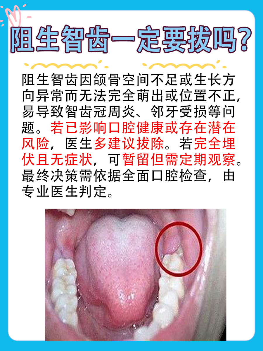 阻生智齿一定要拔吗？揭秘