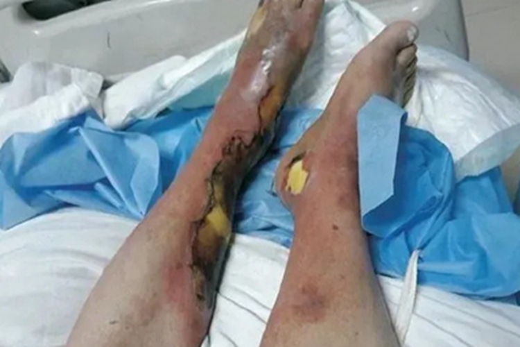 海鱼分枝杆菌感染小腿红肿图