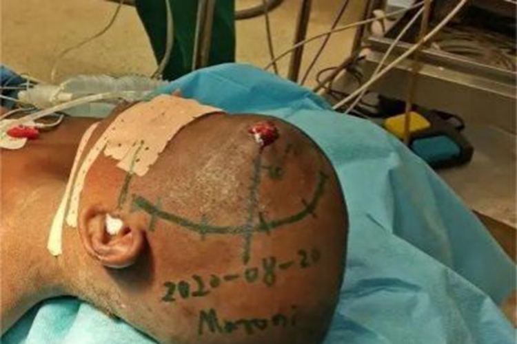 开放性颅脑损伤前额出血图