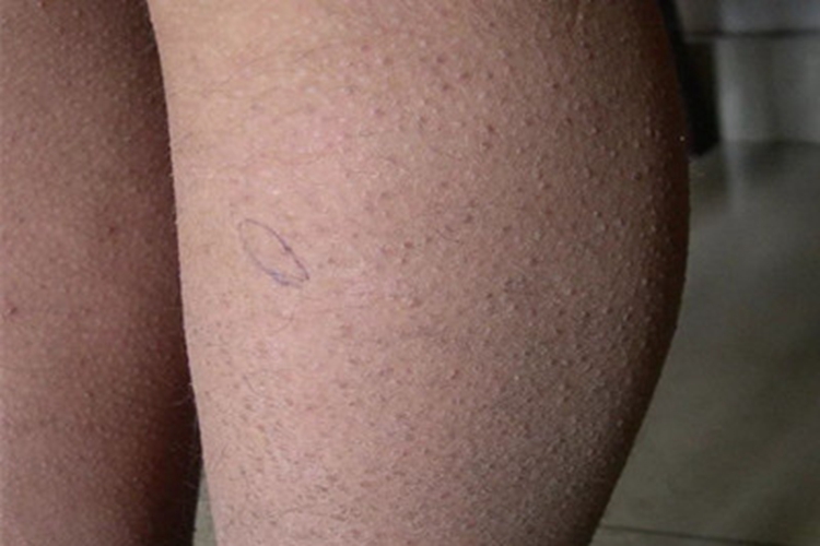 毛发苔藓小腿小疙瘩图