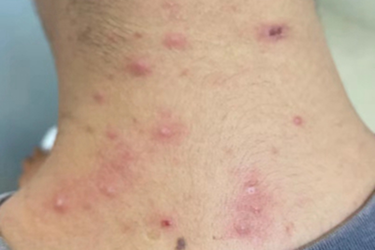 马拉色菌毛囊炎后颈症状图 马拉色菌毛囊炎后颈症状图