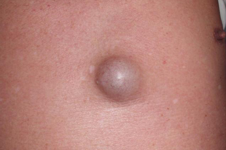 心窝下表皮囊肿图