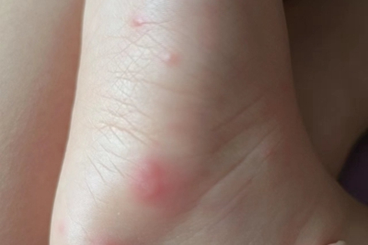 手足口病脚底症状图