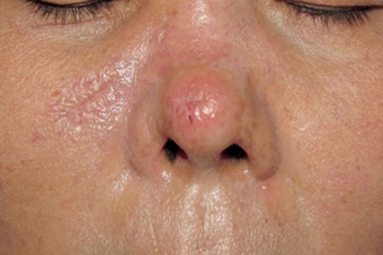 硬化性汗腺导管癌鼻尖长红斑图 硬化性汗腺导管癌鼻尖长红斑图