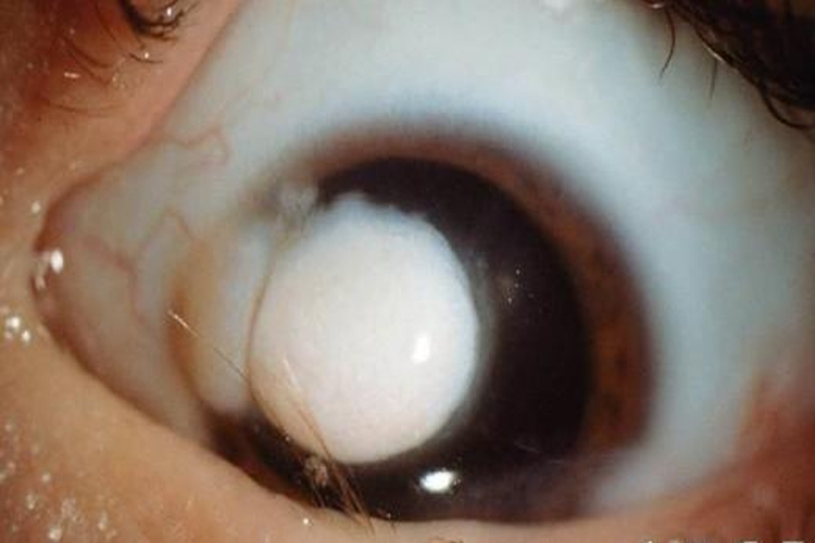 先天性角膜白斑图