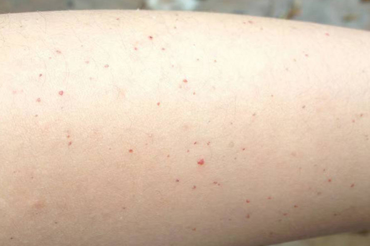 肝硬化皮肤出血图