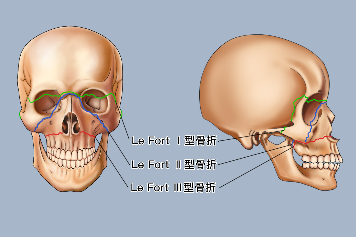 Le Fort骨折分型图