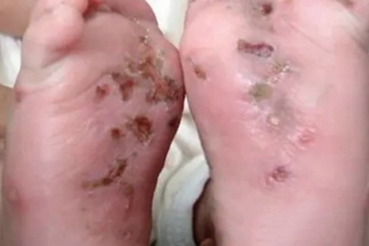 疥疮脚底很多坑伴褐色痂图