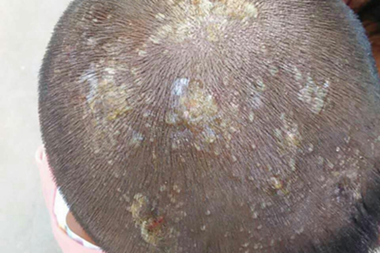 脓窝疮头皮有黄痂图