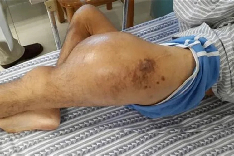 大腿恶性肿瘤的前兆图片_有来医生