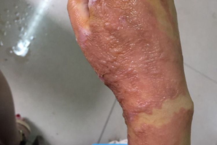 二度烫伤手背症状图 二度烫伤手背症状图