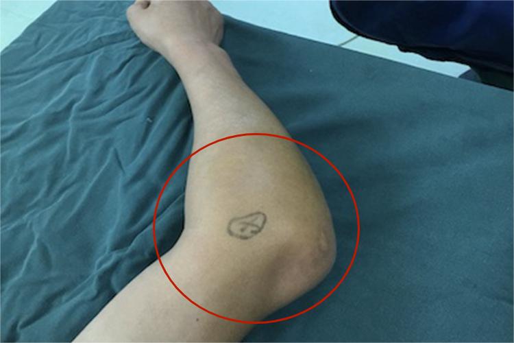 肘关节脱位肿图 肘关节脱位肿图