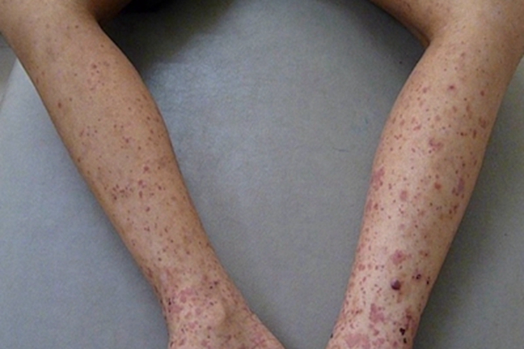 血栓性血小板减少性紫癜结痂图 血栓性血小板减少性紫癜结痂图