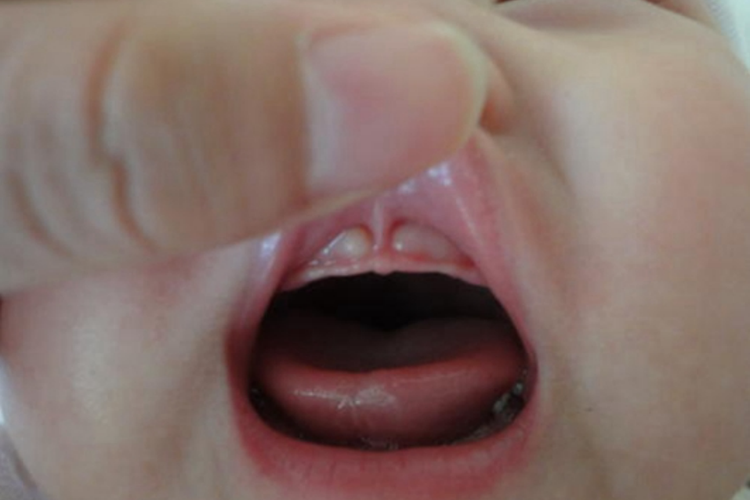 婴儿牙床白色疙瘩图 婴儿牙床白色疙瘩图