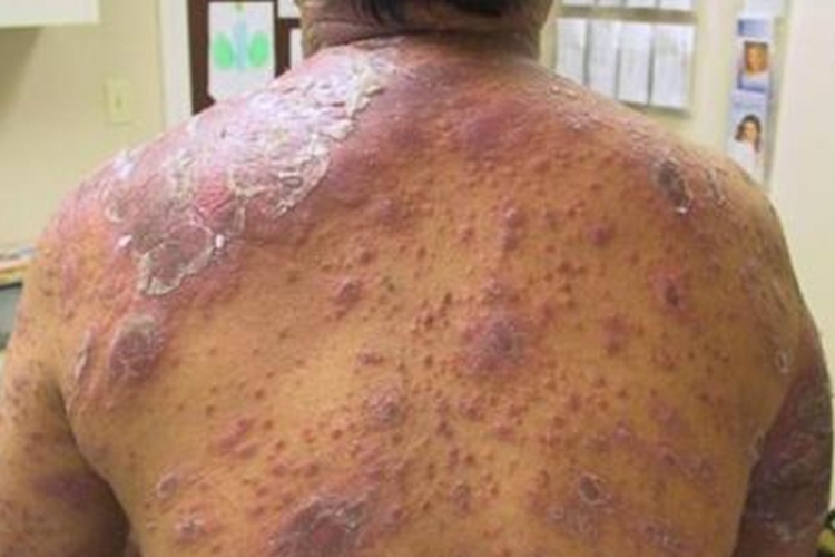 瘤型麻风背部疙瘩图 瘤型麻风背部疙瘩图