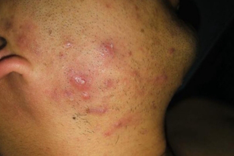 艾滋病感染性皮肤损害面部疙瘩图 艾滋病感染性皮肤损害面部疙瘩图