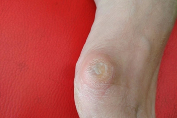 硬鸡眼脚部大疙瘩图 硬鸡眼脚部大疙瘩图