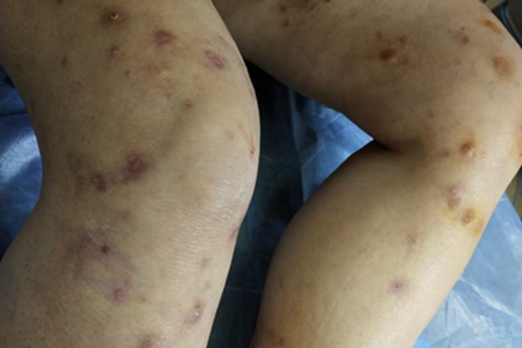 结节性痒疹腿症状图