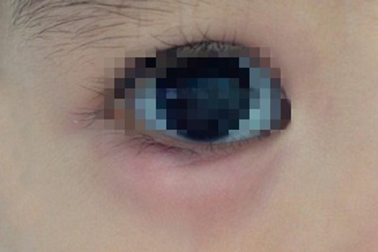 霰粒肿下眼皮有个肿块图