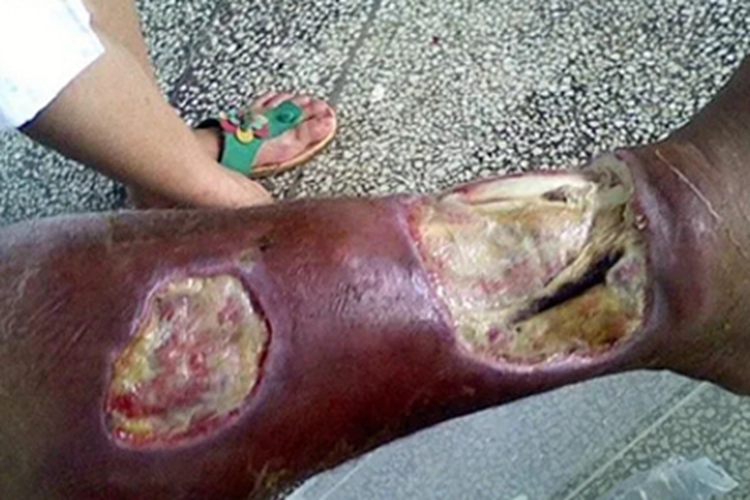 毒蛇咬伤小腿有两个大溃疡图