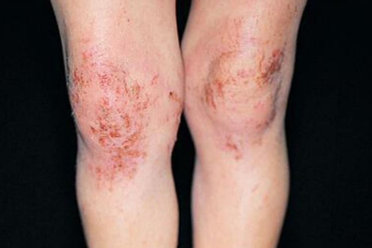 双下肢急性湿疹图