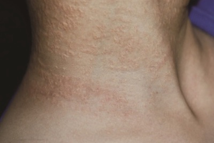 小儿弹性假黄瘤颈部症状图 小儿弹性假黄瘤颈部症状图