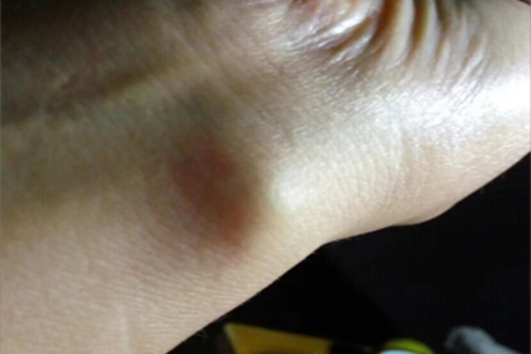 腱鞘纤维瘤手腕症状图 腱鞘纤维瘤手腕症状图