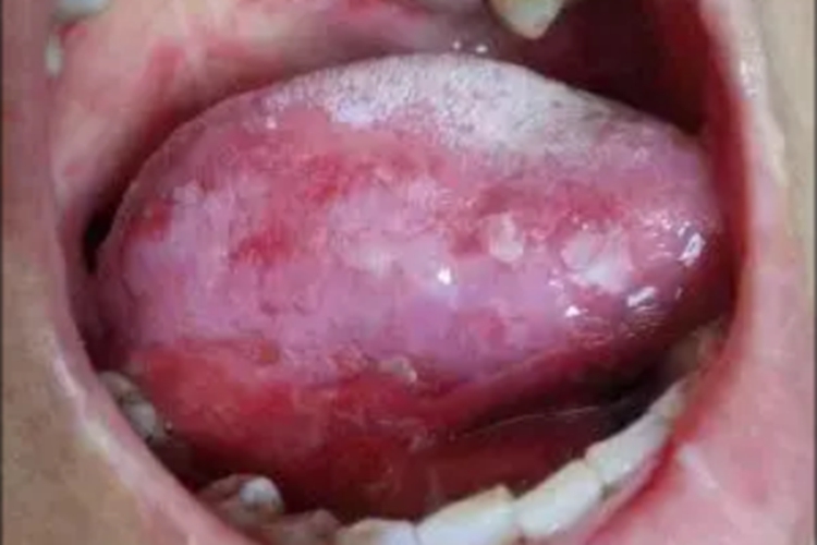 口腔黏膜结核性溃疡舌侧白斑图 口腔黏膜结核性溃疡舌侧白斑图