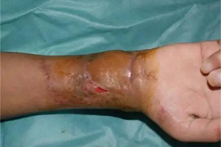 电烧伤手腕有大水疱图 电烧伤手腕有大水疱图