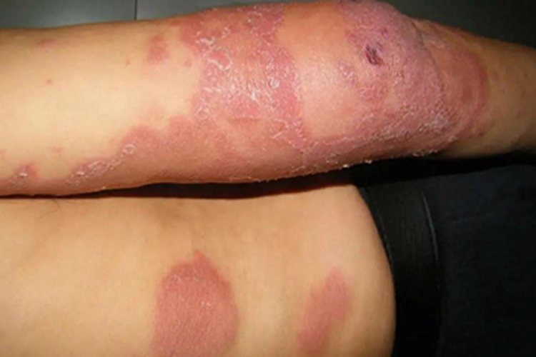 麻风病腿症状图 麻风病腿症状图