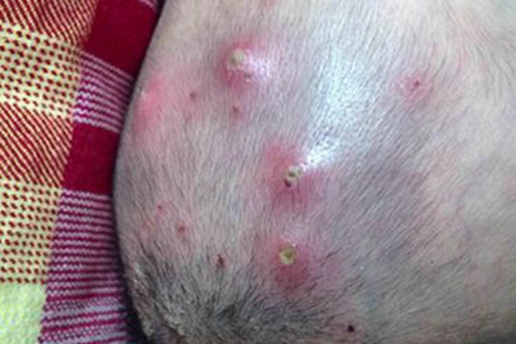 毛囊炎头皮症状图