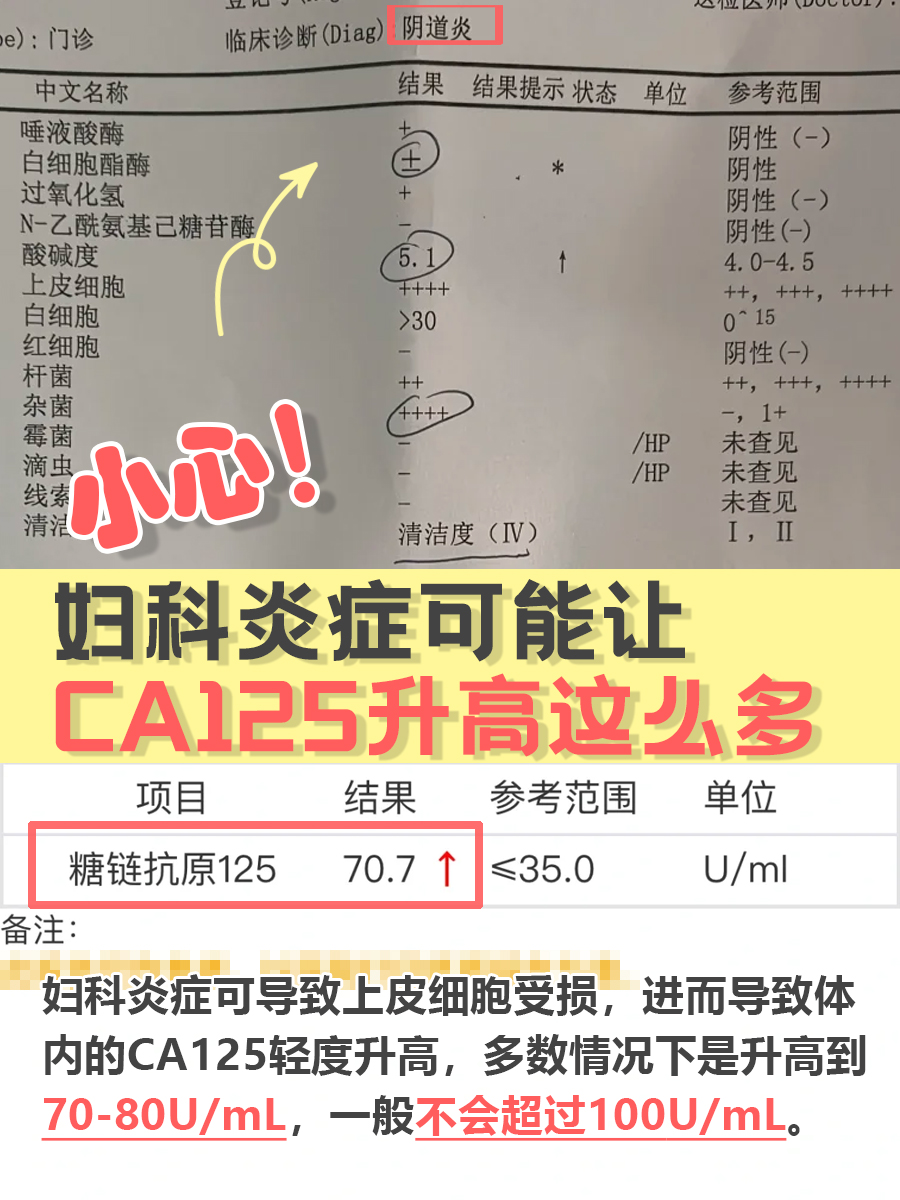 小心！妇科炎症可能让CA125升高这么多