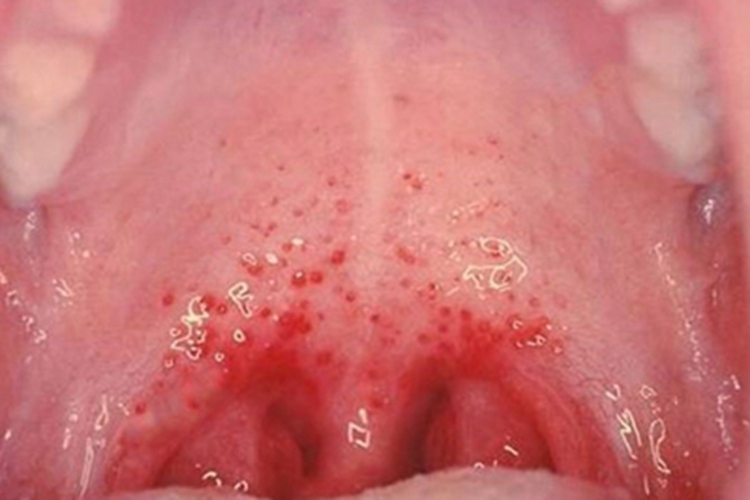 传染性单核细胞增多症喉咙红点图 传染性单核细胞增多症喉咙红点图