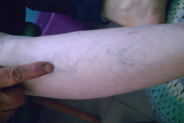 胳膊静脉曲张图