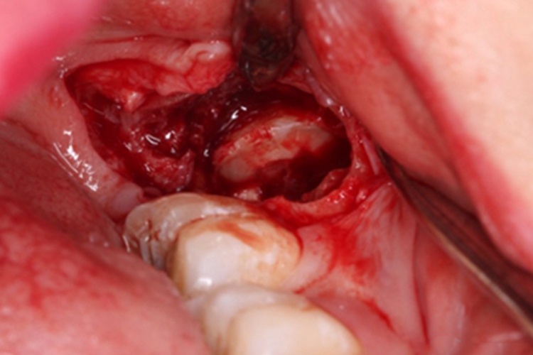 拔除阻生牙的牙冠图