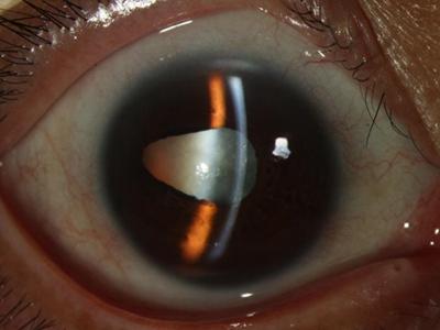 核性白内障眼球里有不规则的白斑图.jpeg