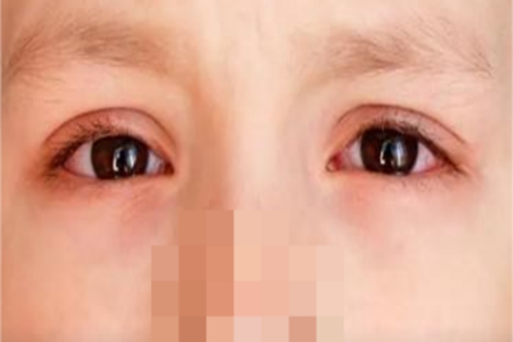 儿童过敏性结膜炎眼睛周围红肿图 儿童过敏性结膜炎眼睛周围红肿图