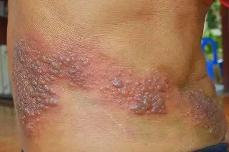 腰部带状疱疹红疹瘙痒图