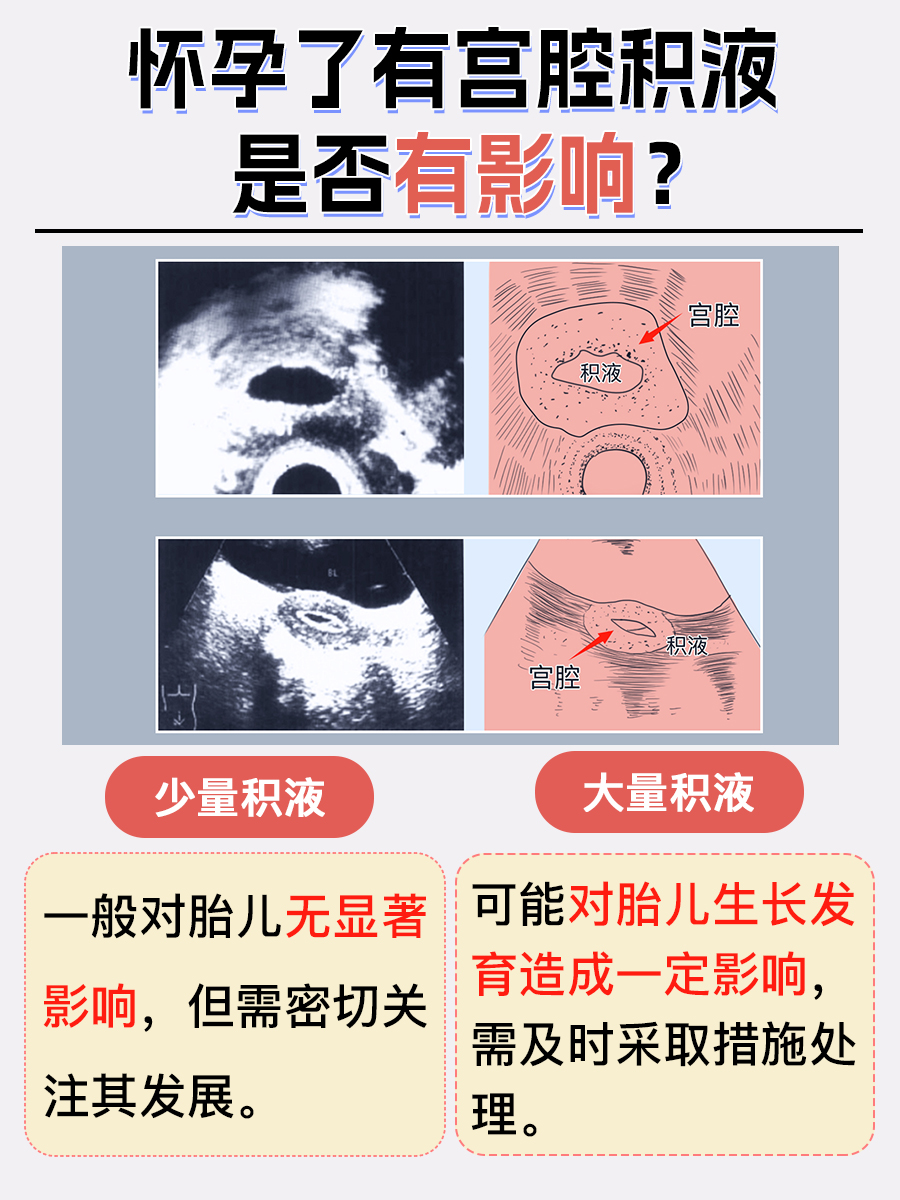 怀孕了有积液怎么办?有影响不?