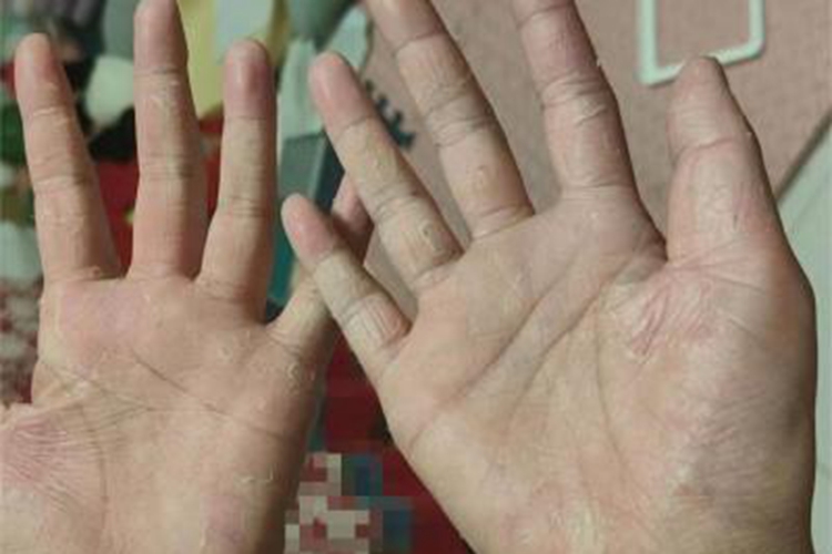 剥脱性角质松解症手部脱皮图 剥脱性角质松解症手部脱皮图