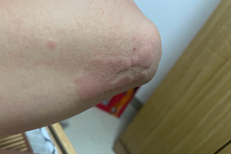 荨麻疹肘部红斑图