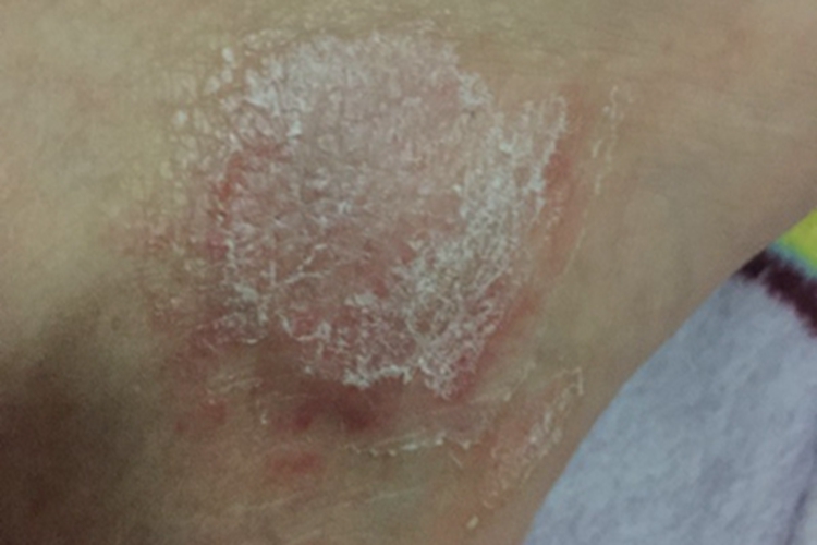 鳞屑角化型足癣脚踝脱屑图 鳞屑角化型足癣脚踝脱屑图