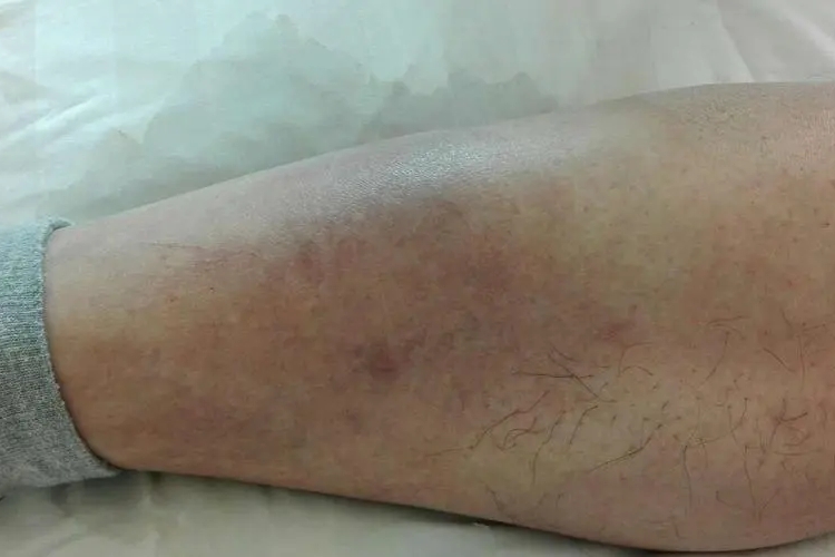 网状淋巴管炎图