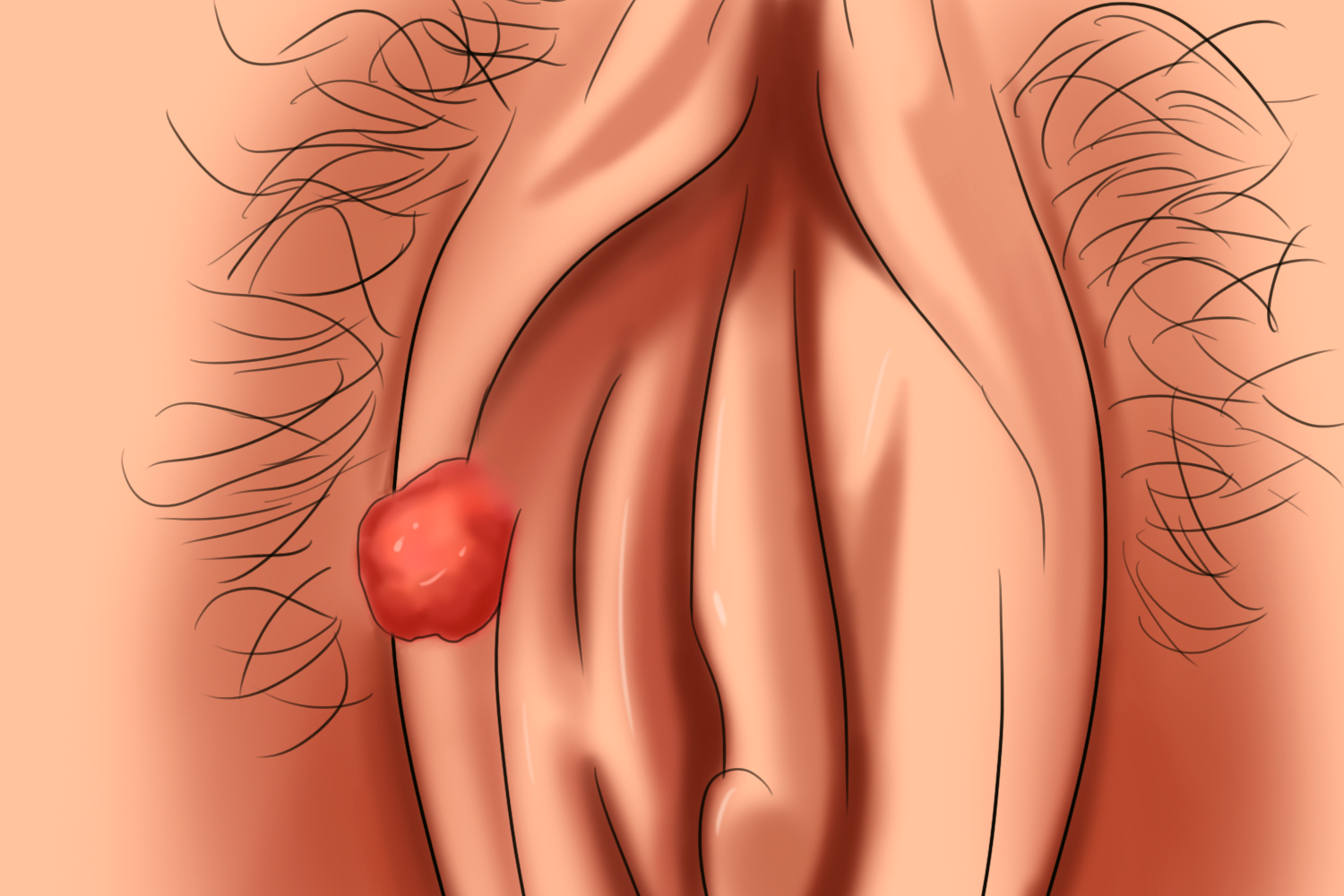 外阴癌图 外阴癌图