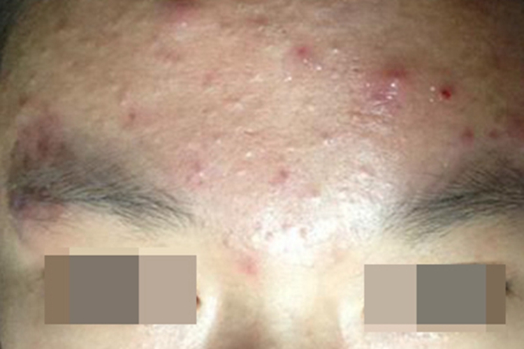 聚合性痤疮前额有脓包图