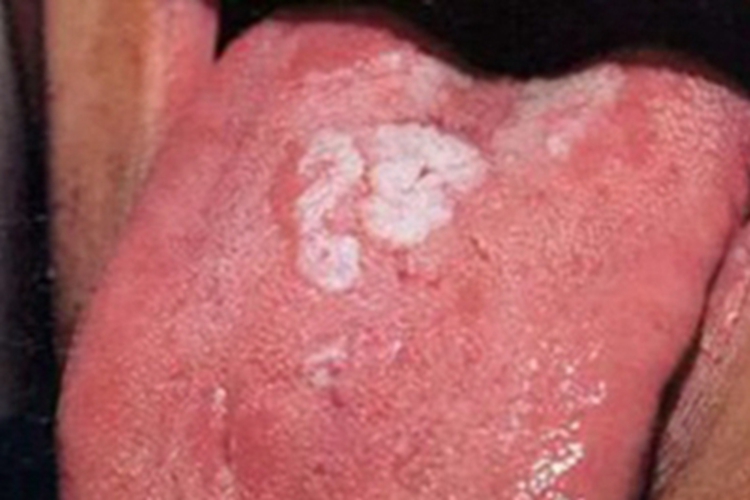 女性二期梅毒舌头症状图 女性二期梅毒舌头症状图